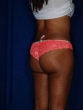 Liposuction Before & After