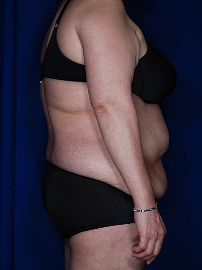Liposuction Before & After