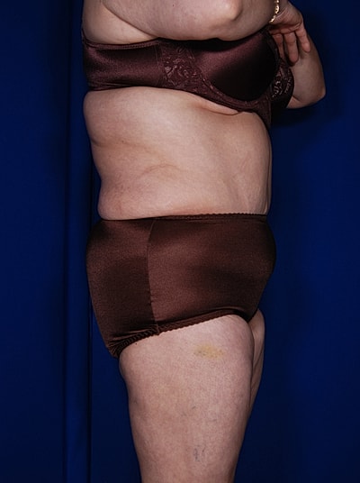 Liposuction Before & After