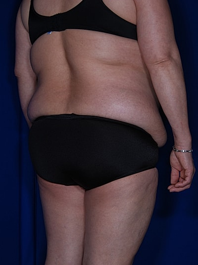 Liposuction Before & After