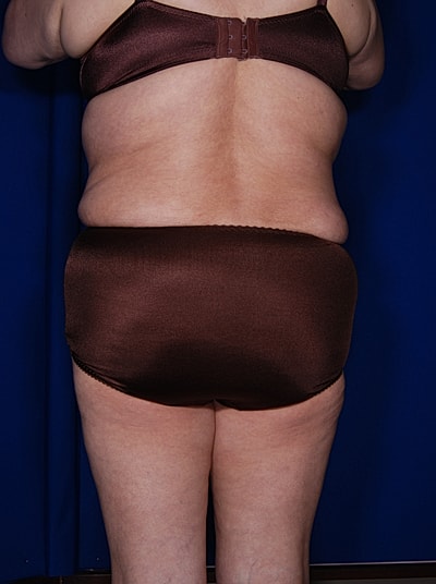 Liposuction Before & After