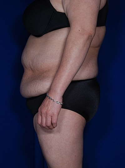 Liposuction Before & After