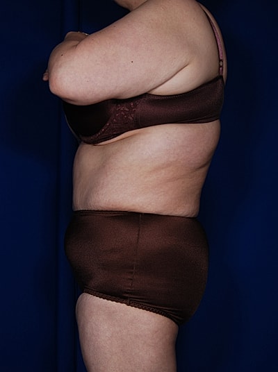 Liposuction Before & After