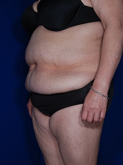 Liposuction Before & After