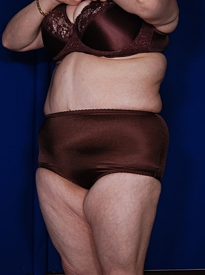 Liposuction Before & After