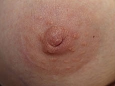 Inverted Nipple Correction Before & After