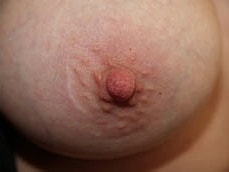 Inverted Nipple Correction Before & After