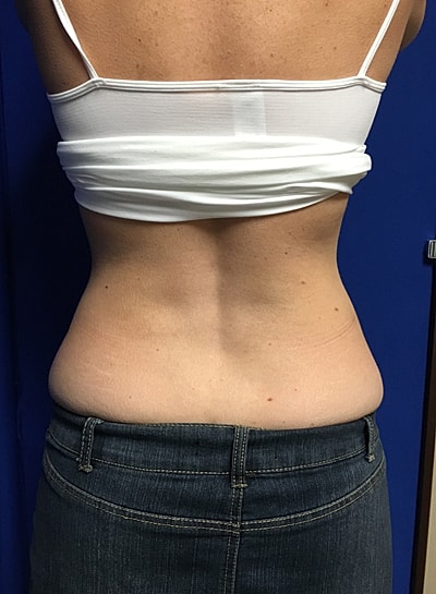 Coolsculpting Before & After