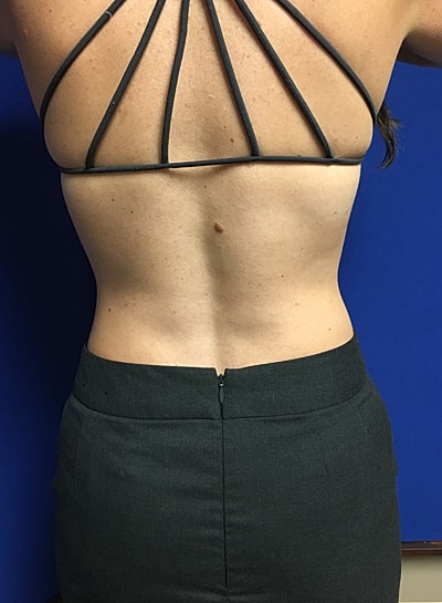 Coolsculpting Before & After