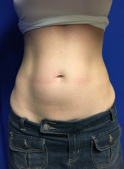 Coolsculpting Before & After