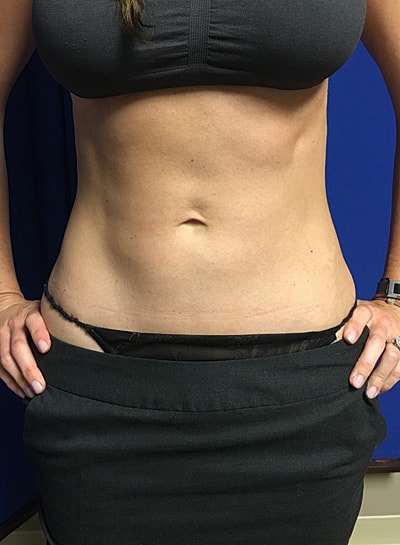 Coolsculpting Before & After