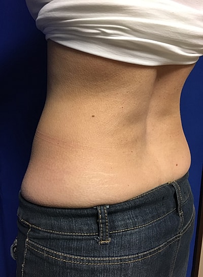 Coolsculpting Before & After