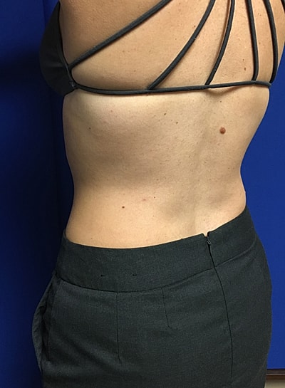 Coolsculpting Before & After