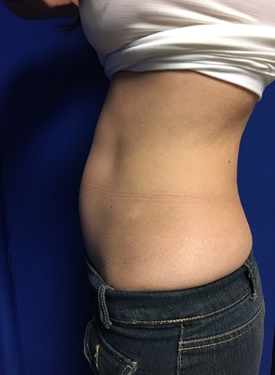 Coolsculpting Before & After