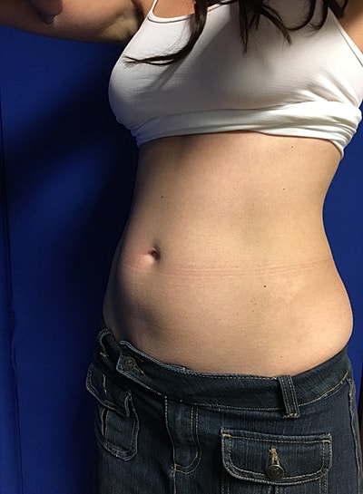 Coolsculpting Before & After