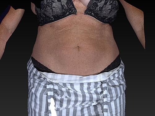 Coolsculpting Before & After