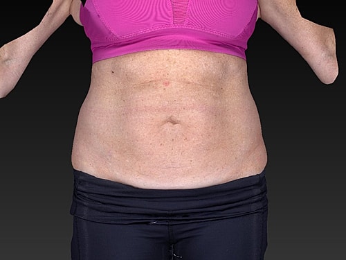 Coolsculpting Before & After