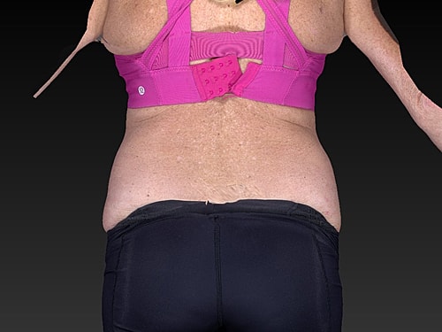 Coolsculpting Before & After