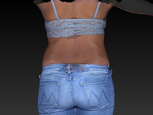 Coolsculpting Before & After
