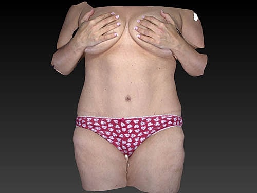 Coolsculpting Before & After