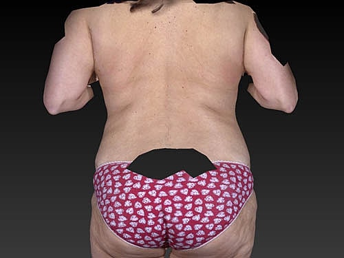 Coolsculpting Before & After