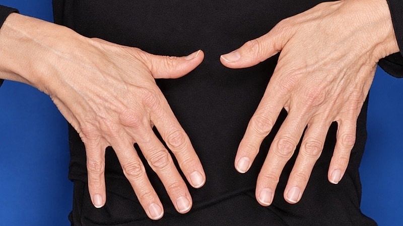 Hand Rejuvenation Before & After