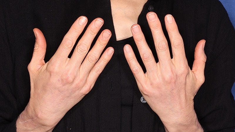Hand Rejuvenation Before & After
