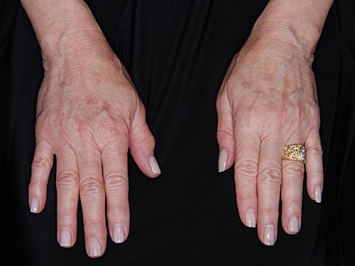 Hand Rejuvenation Before & After
