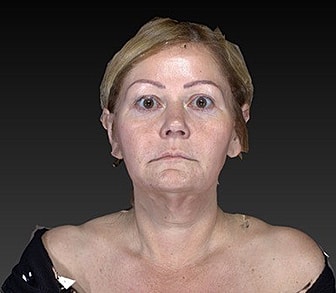 Eyelid Lift Before & After