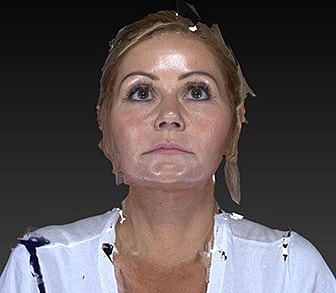 Eyelid Lift Before & After