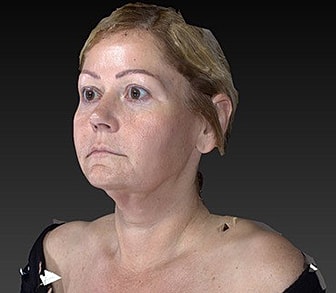 Eyelid Lift Before & After