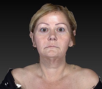 Eyelid Lift Before & After