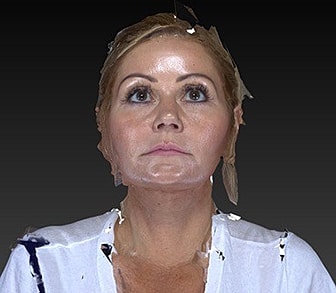 Eyelid Lift Before & After