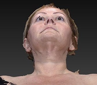 Eyelid Lift Before & After