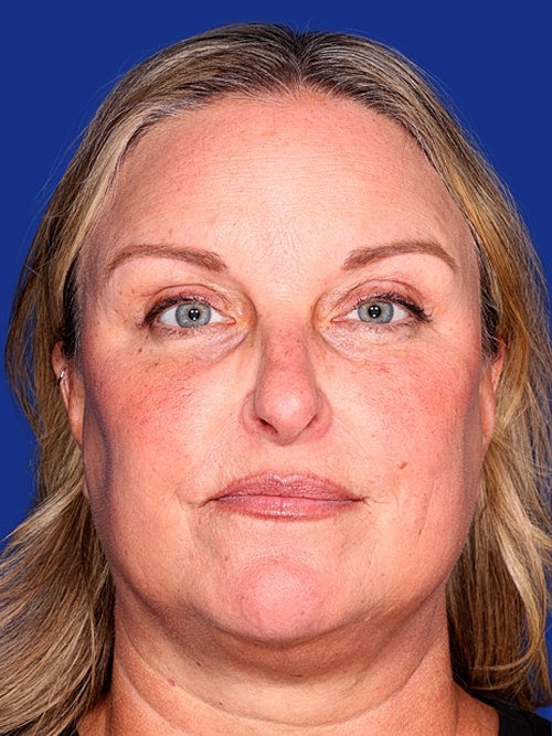 Eyelid Lift Before & After