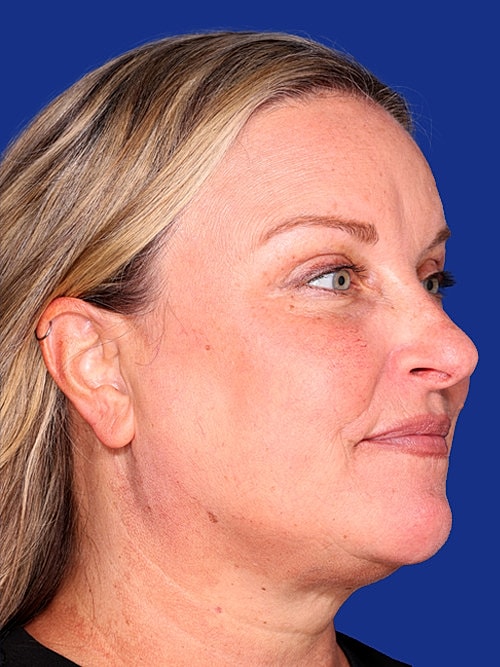 Eyelid Lift Before & After