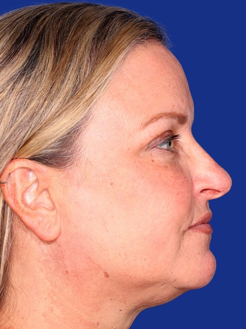 Eyelid Lift Before & After