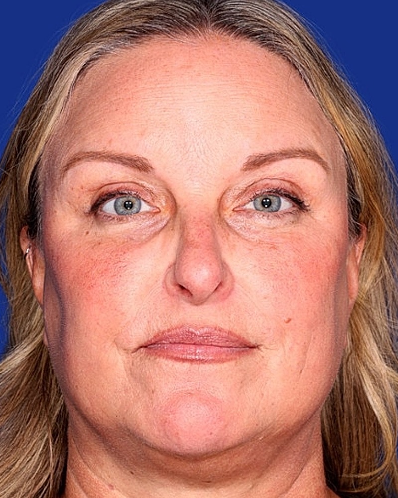 Eyelid Lift Before & After