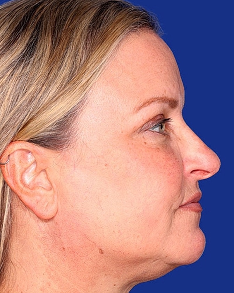 Eyelid Lift Before & After