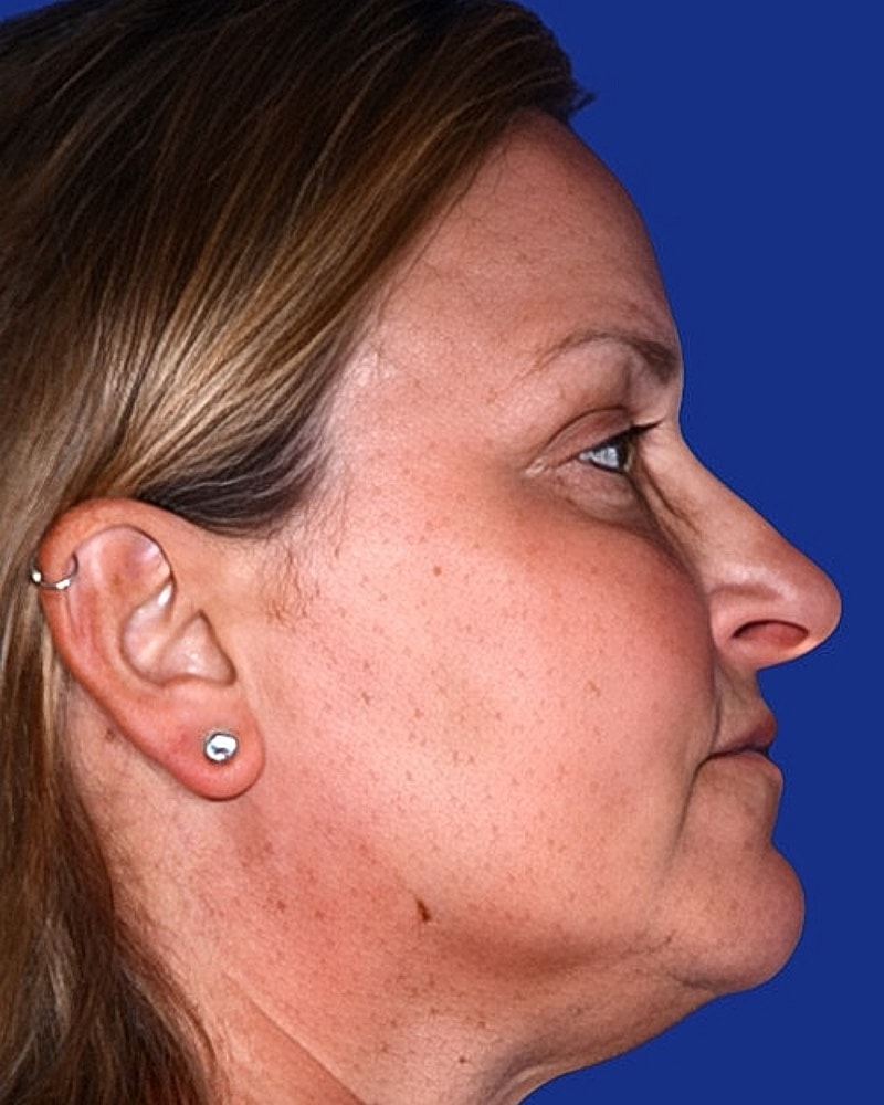 Eyelid Lift Before & After