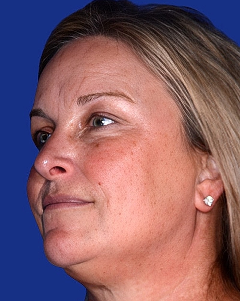 Eyelid Lift Before & After