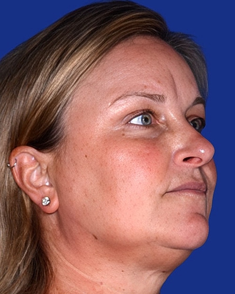 Eyelid Lift Before & After