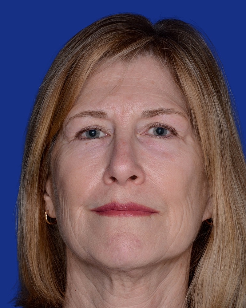 Eyelid Lift | Blepharoplasty Before & After