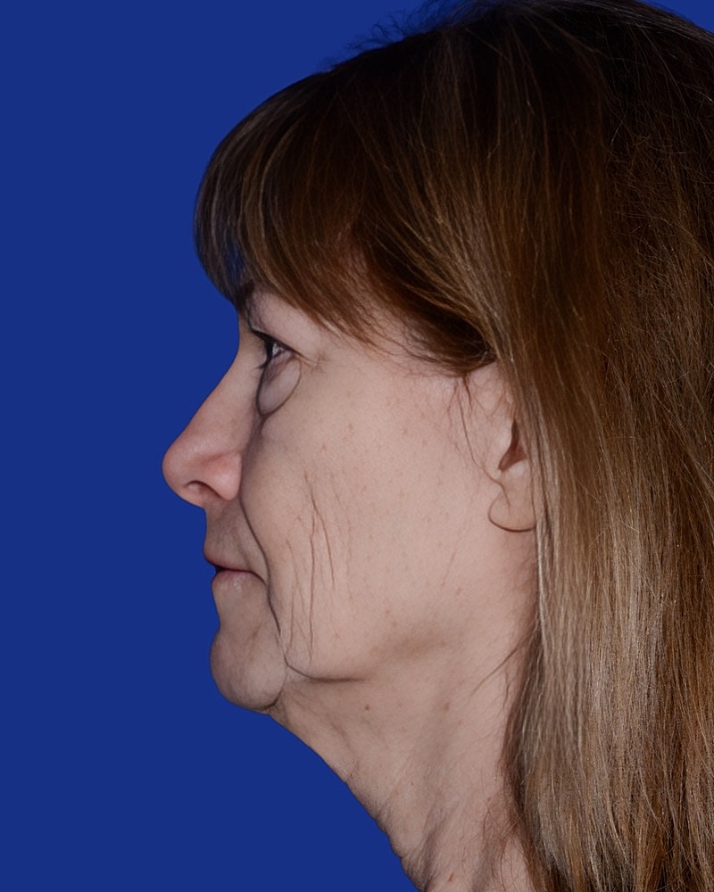 Eyelid Lift | Blepharoplasty Before & After