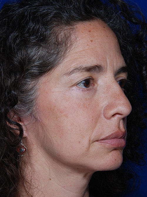 Eyelid Lift Before & After