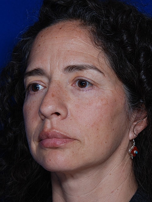 Eyelid Lift Before & After