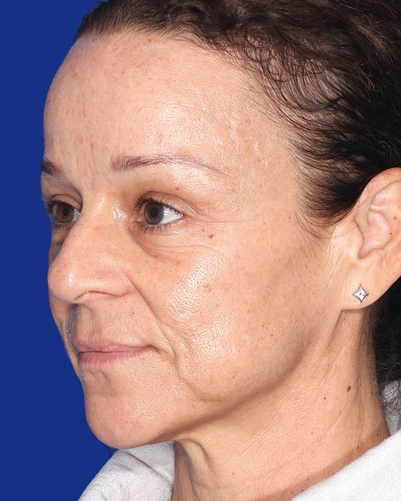 Eyelid Lift Before & After