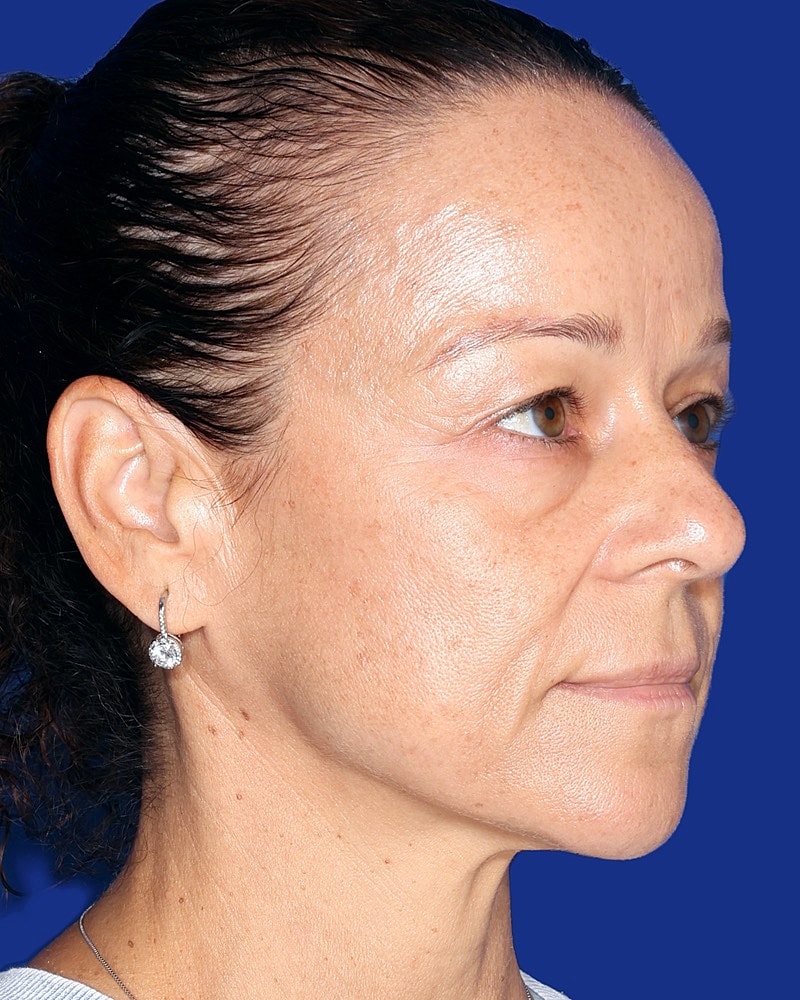 Eyelid Lift Before & After