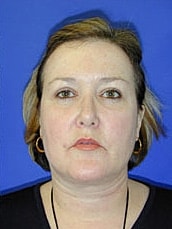Eyelid Lift Before & After