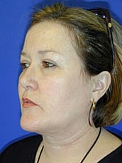 Eyelid Lift Before & After